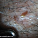 Protruding blackhead on a hairy chest.